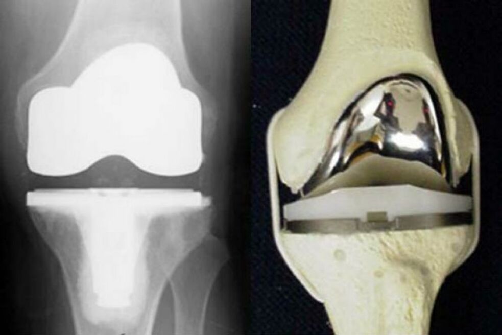 Knee joint replacement for osteoarthritis