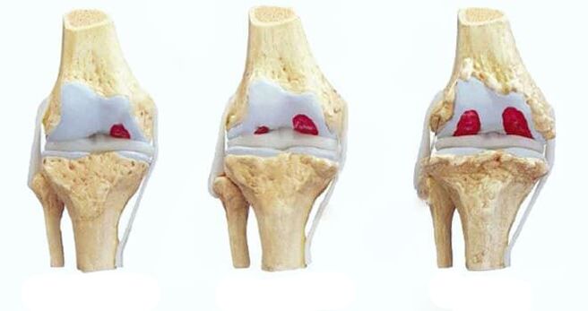 knee osteoarthritis stages