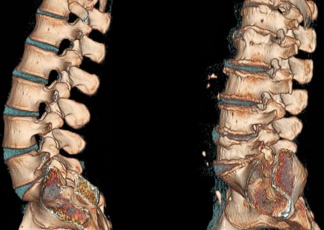 Osteochondrosis of the lumbar region