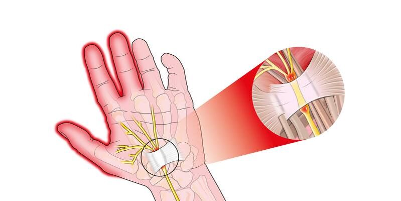 Pain in fingers with risarrosis