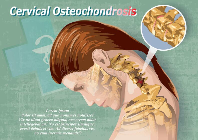 Cervical osteochondrosis is a disease of cartilage tissue.