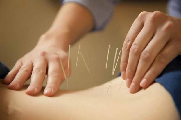 treatment of osteochondrosis with acupuncture