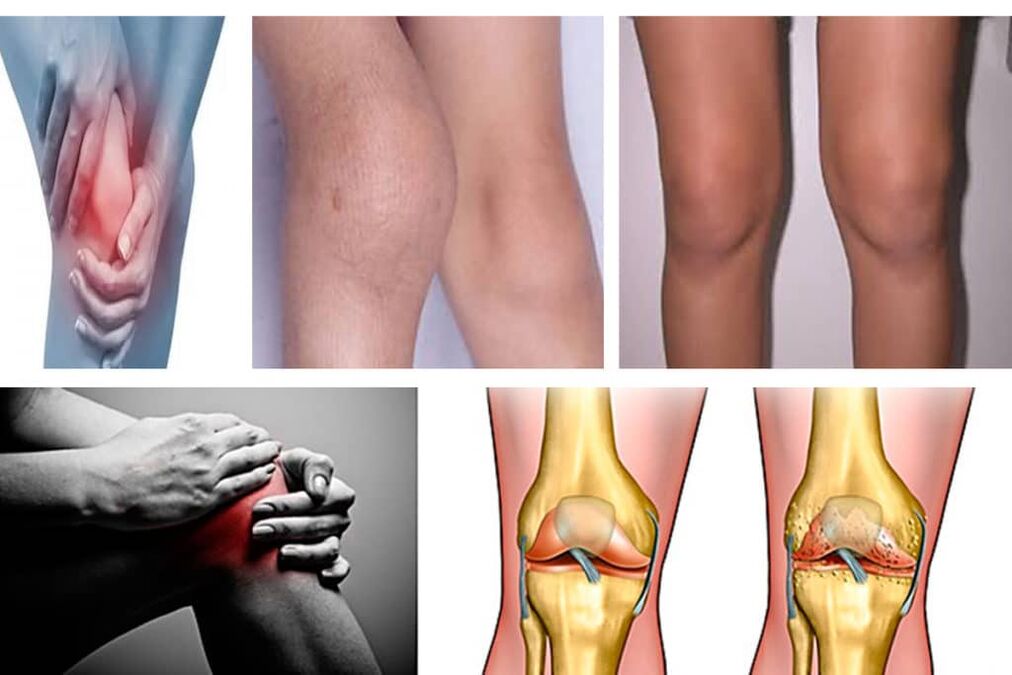 knee osteoarthritis symptoms