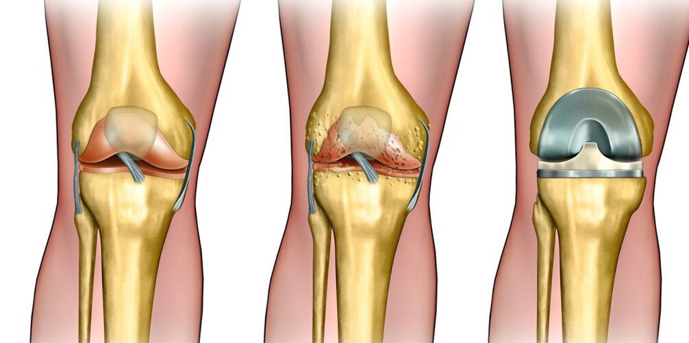 osteoarthritis of the knee joint